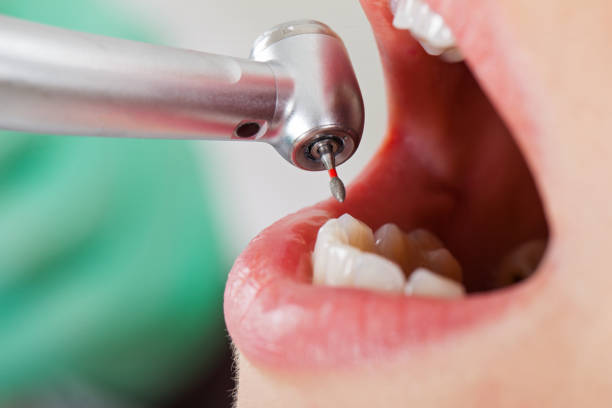 Best Urgent Care for Lost Fillings or Crowns in Avon, OH